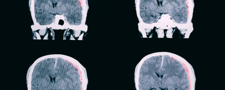 Traumatic brain injured patient with large left subdural hematoma