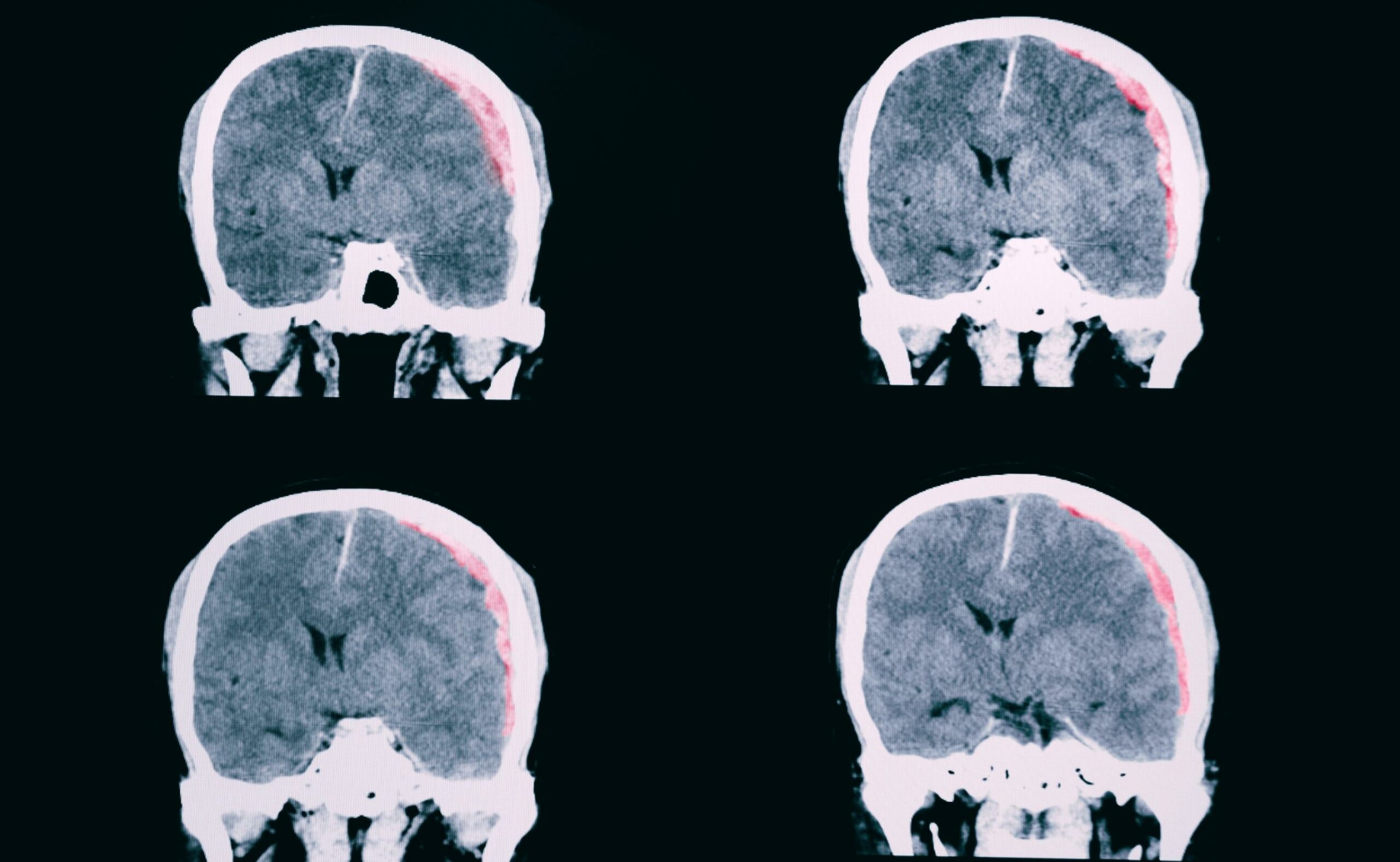 Traumatic brain injured patient with large left subdural hematoma