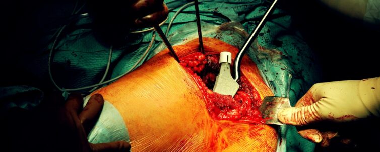 Prothesis of the hip hospital operation