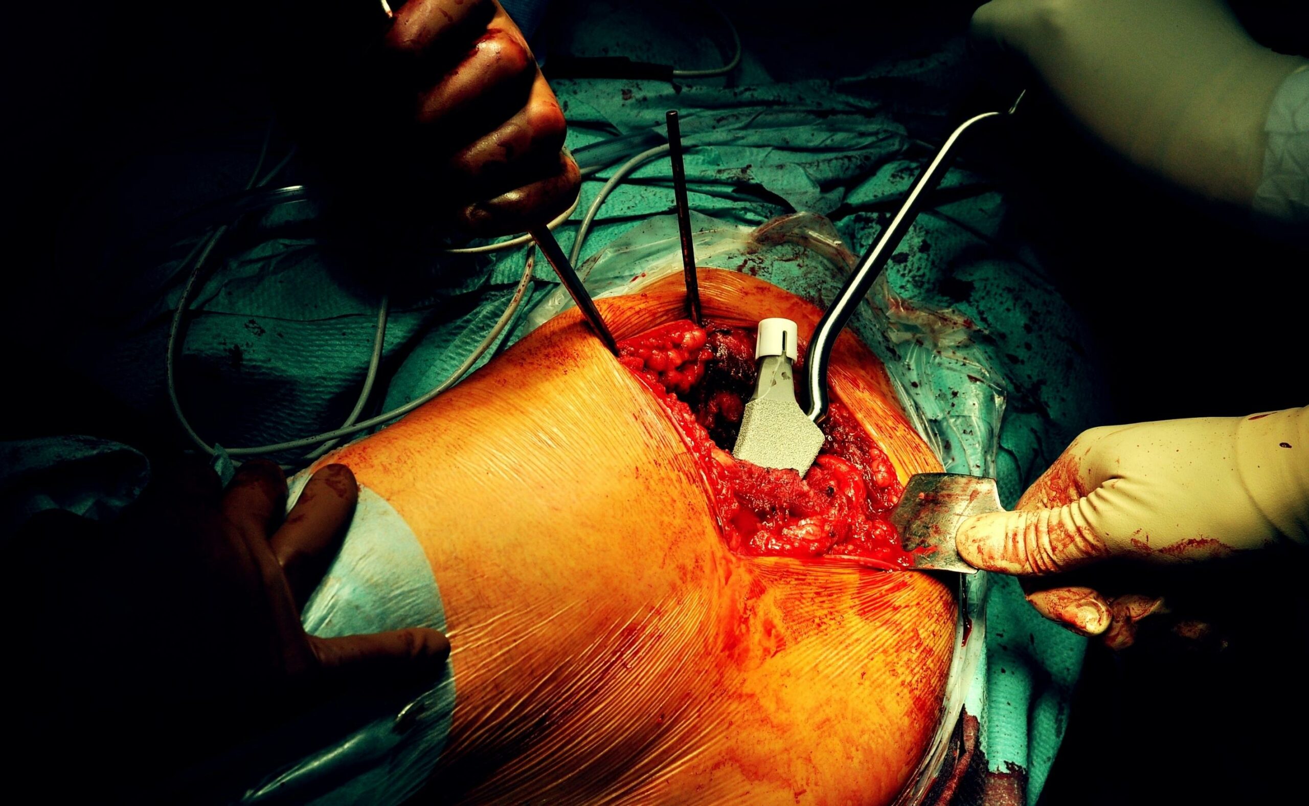 Prothesis of the hip hospital operation