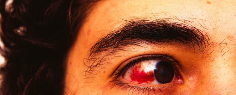 Man with red eye and ugly eyebrows and curly hair with pimples on the forehead