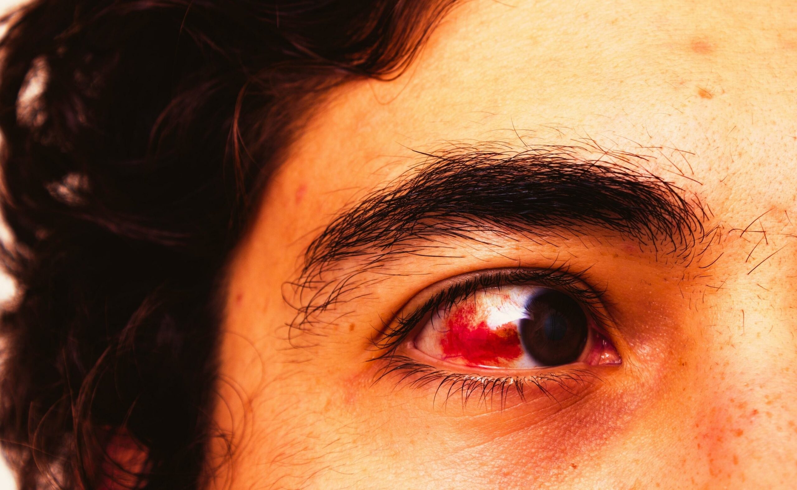 Man with red eye and ugly eyebrows and curly hair with pimples on the forehead