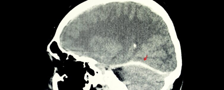 xray of traumatic brain injury
