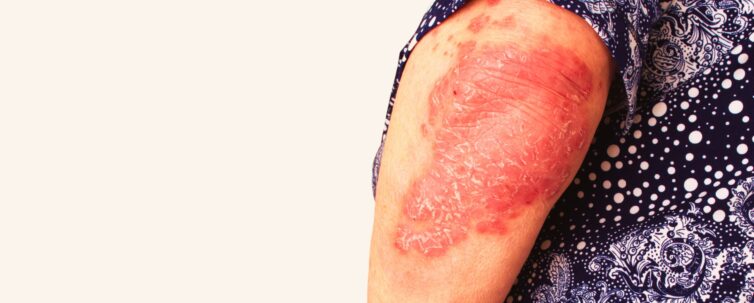 Psoriasis, psoriatic skin disease