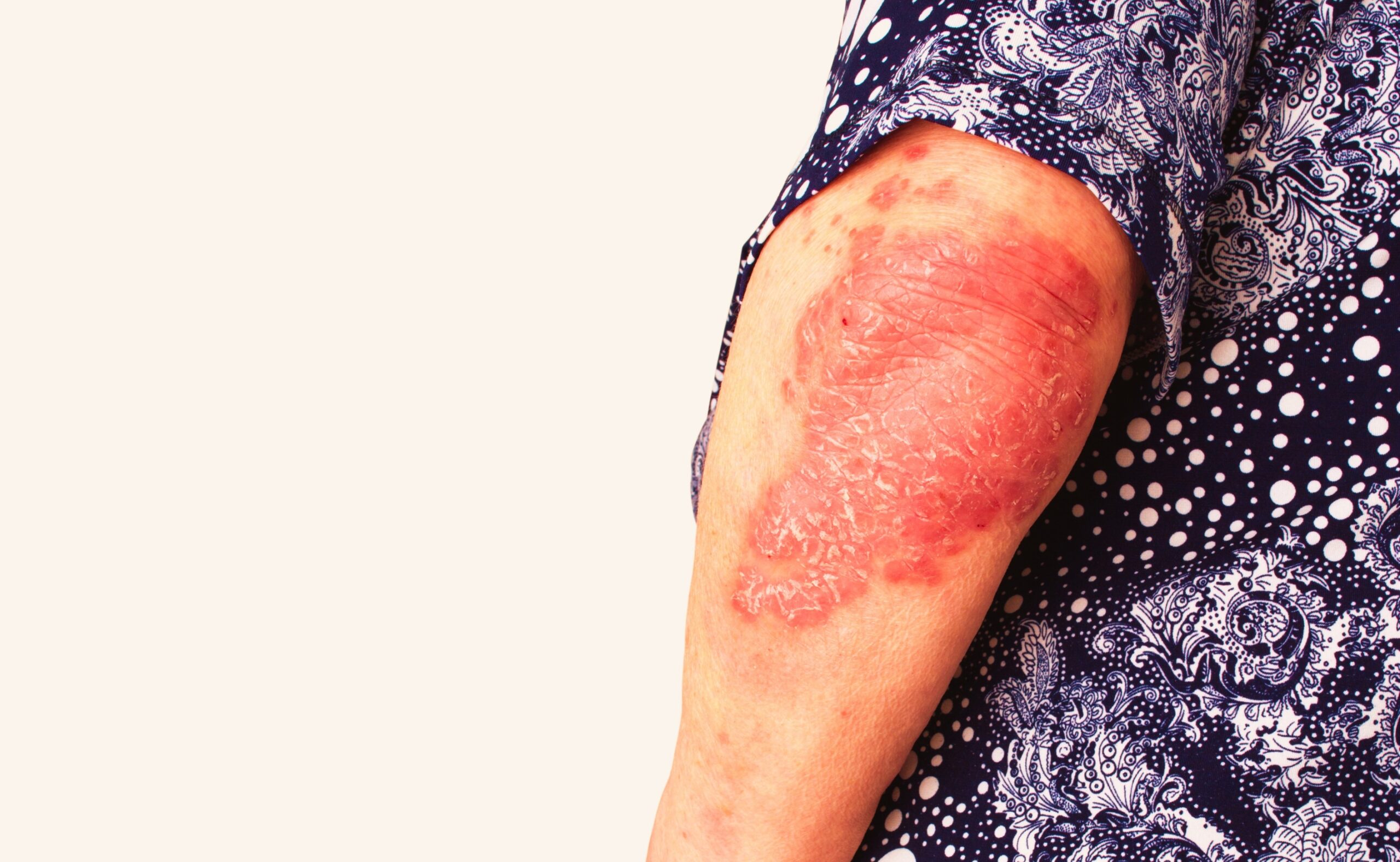 Psoriasis, psoriatic skin disease