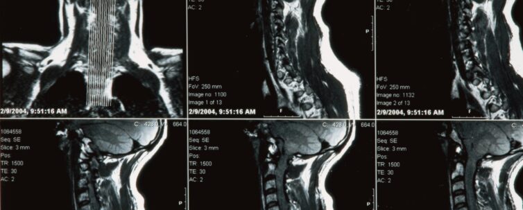 Xray of human neck (broken)