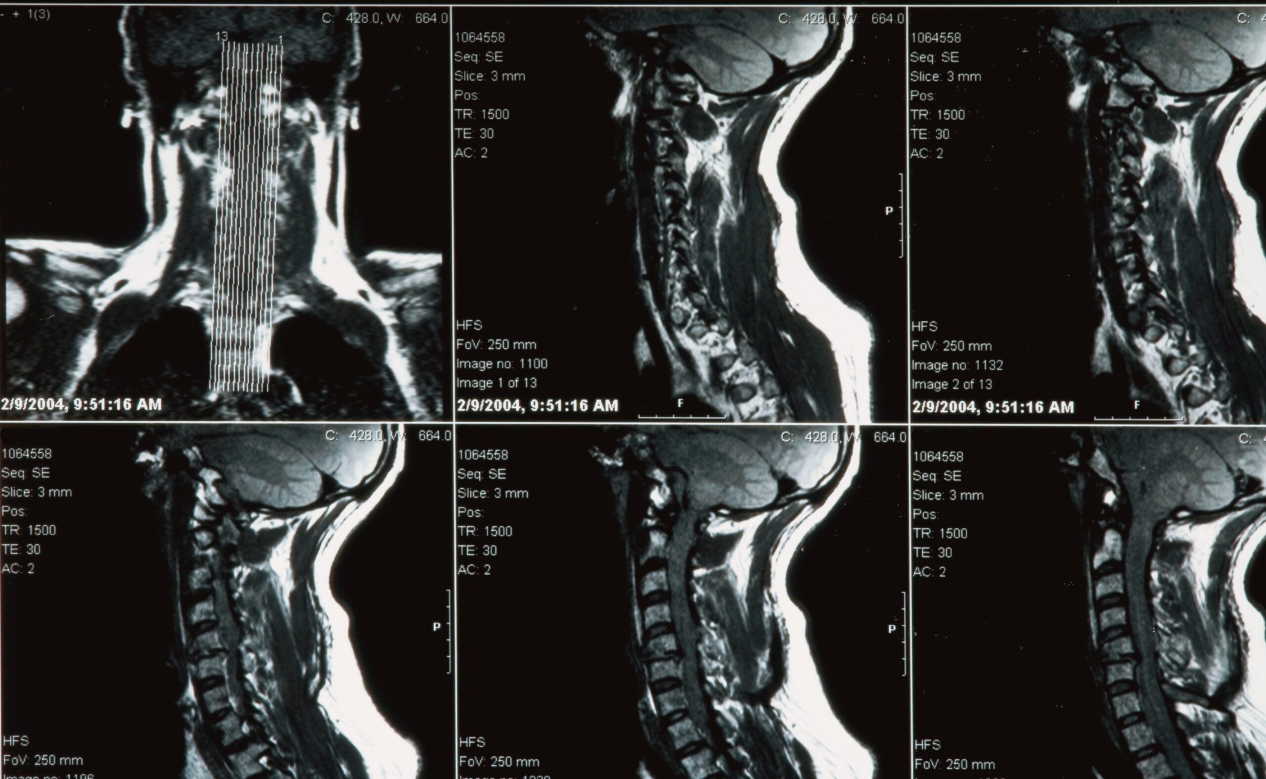 Xray of human neck (broken)