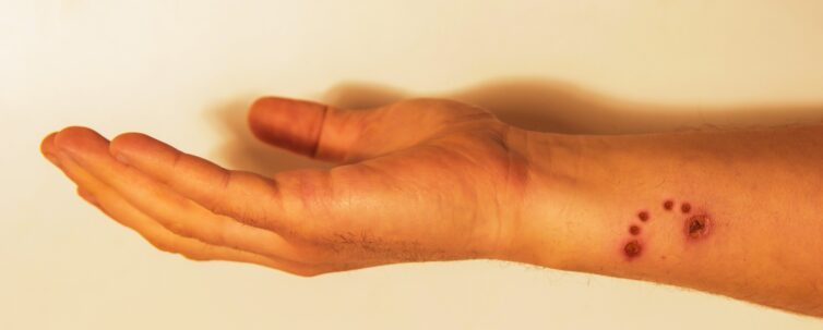 bite of a large dog. Hand injury