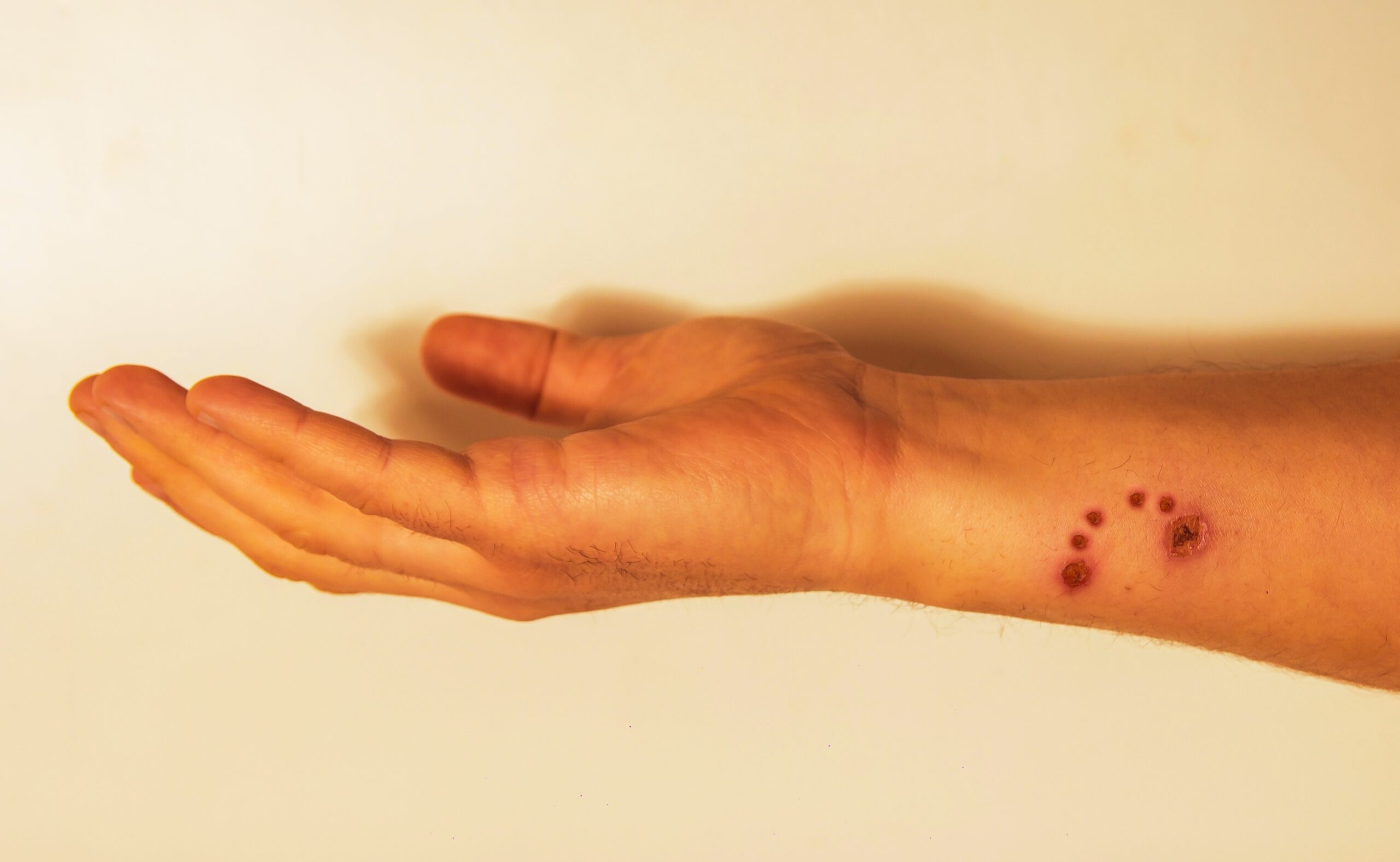 bite of a large dog. Hand injury