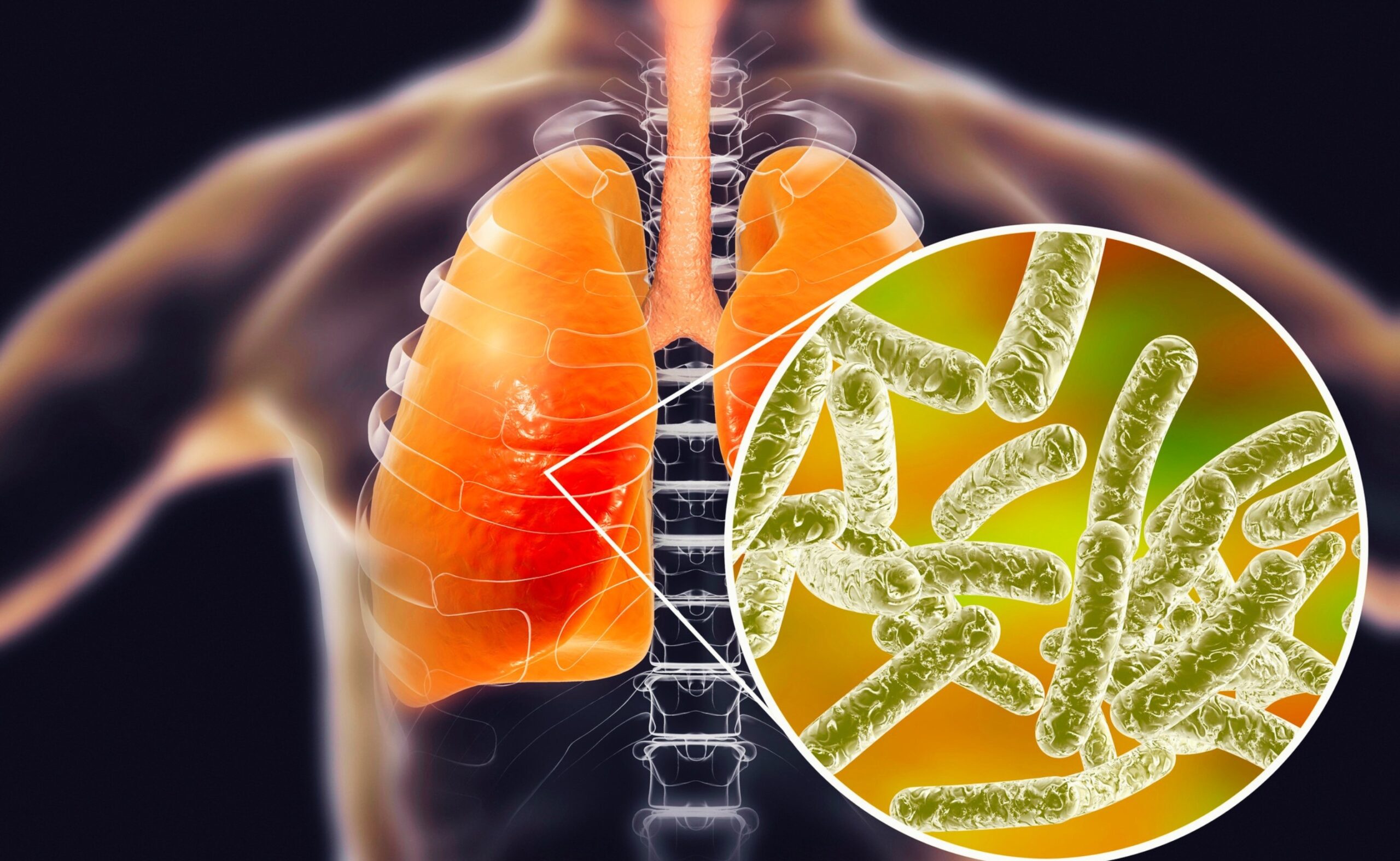 Legionnaires' disease, conceptual computer illustration. Legionella pneumophila bacteria are the cause of Legionnaires' disease. These bacilli (rod-shaped bacteria) are Gram-negative. L. pneumophila was identified as a pathogen after a mysterious outbreak.